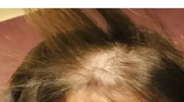 فشل جلسة تجميل.. فنانة مصرية تفقد شعرها بالكامل