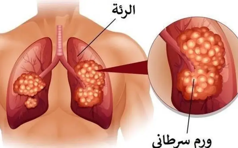 دواء تجريبي جديد يُظهر نتائج واعدة في تبطئة تطور سرطان الرئة والبنكرياس